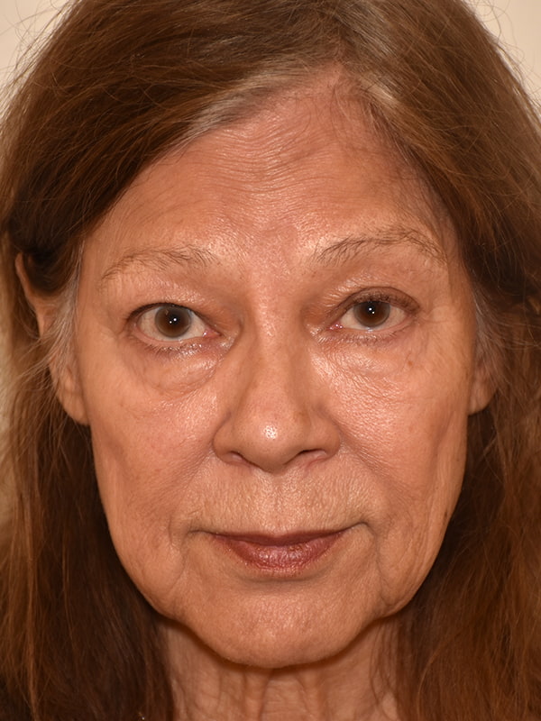 Blepharoplasty Before & After Image