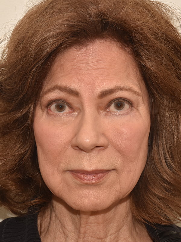 Blepharoplasty Before & After Image