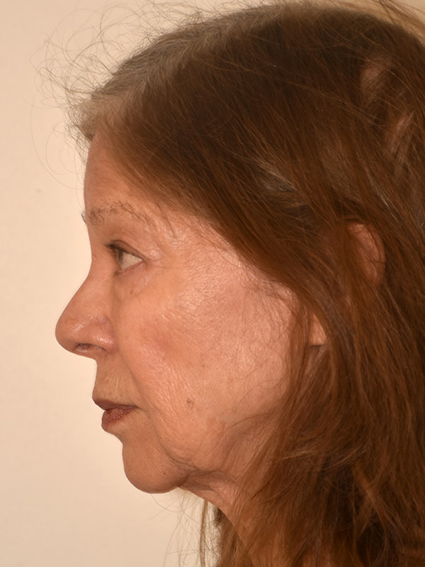 Blepharoplasty Before & After Image