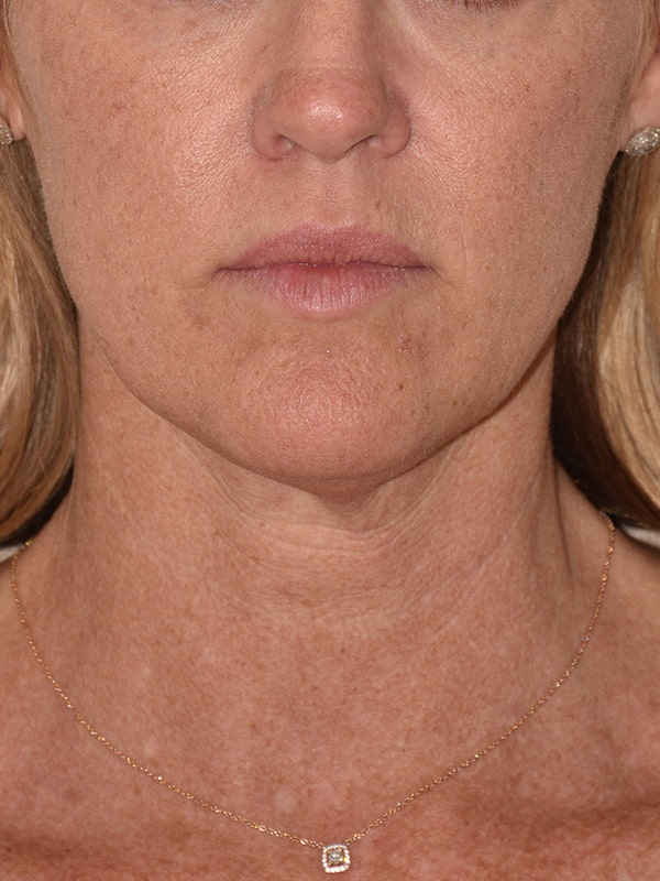 Facelift Before & After Image