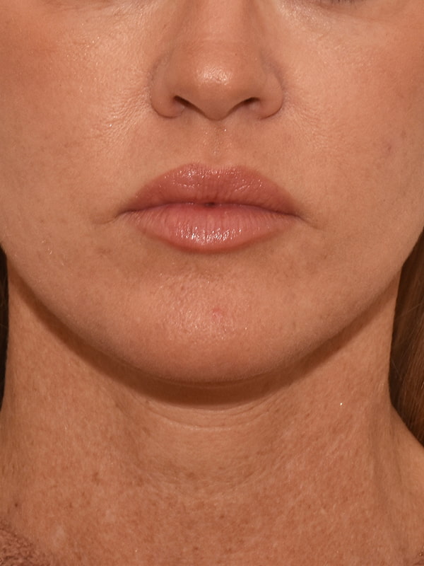 Facelift Before & After Image