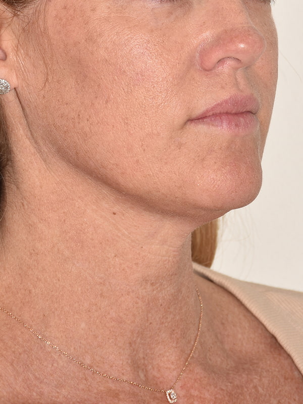 Facelift Before & After Image