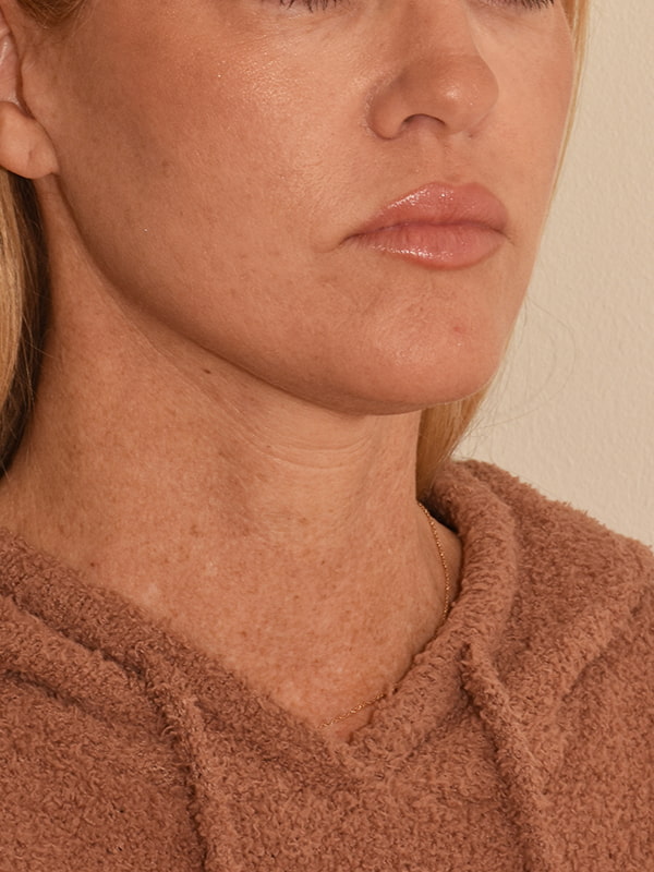 Facelift Before & After Image