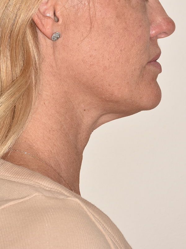 Facelift Before & After Image