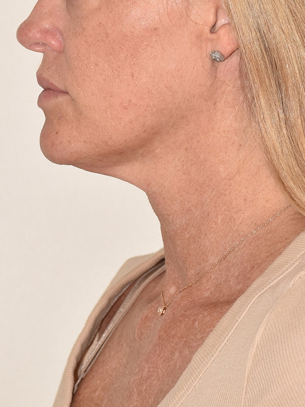 Facelift Before & After Image