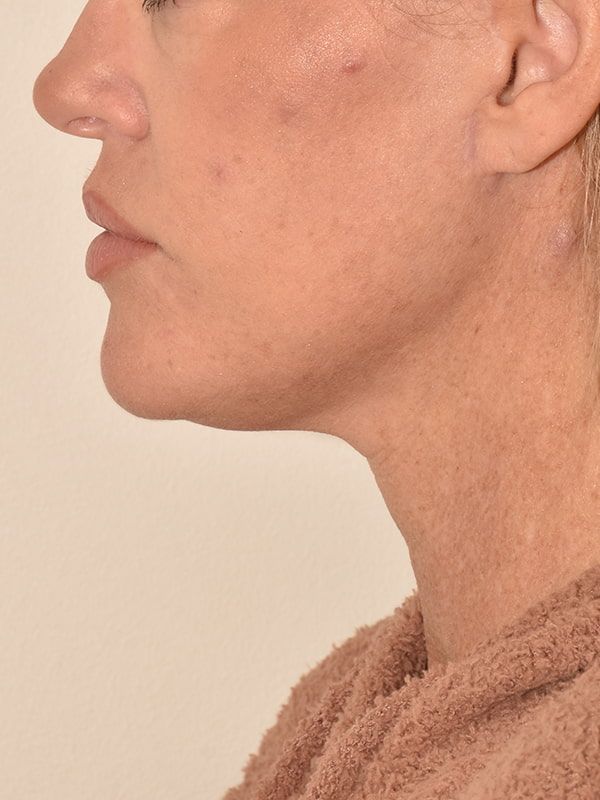 Facelift Before & After Image