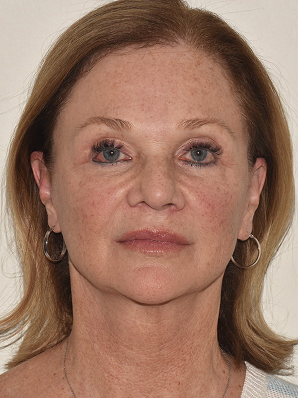 Facelift Before & After Image