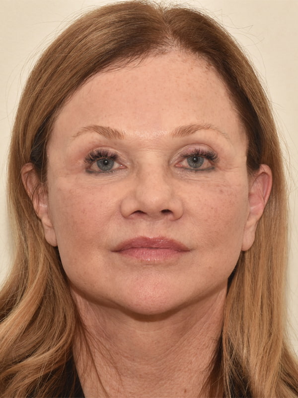 Facelift Before & After Image