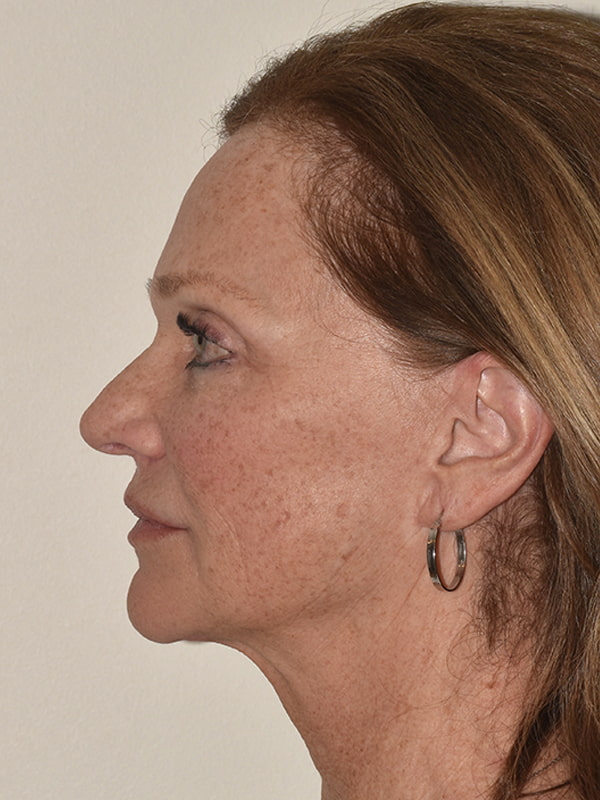 Facelift Before & After Image