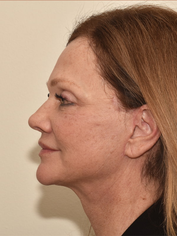 Facelift Before & After Image