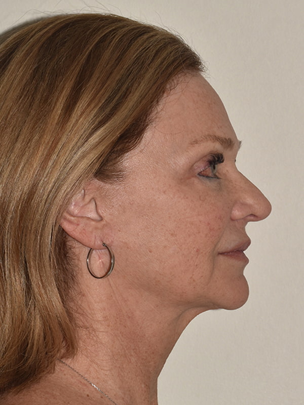 Facelift Before & After Image