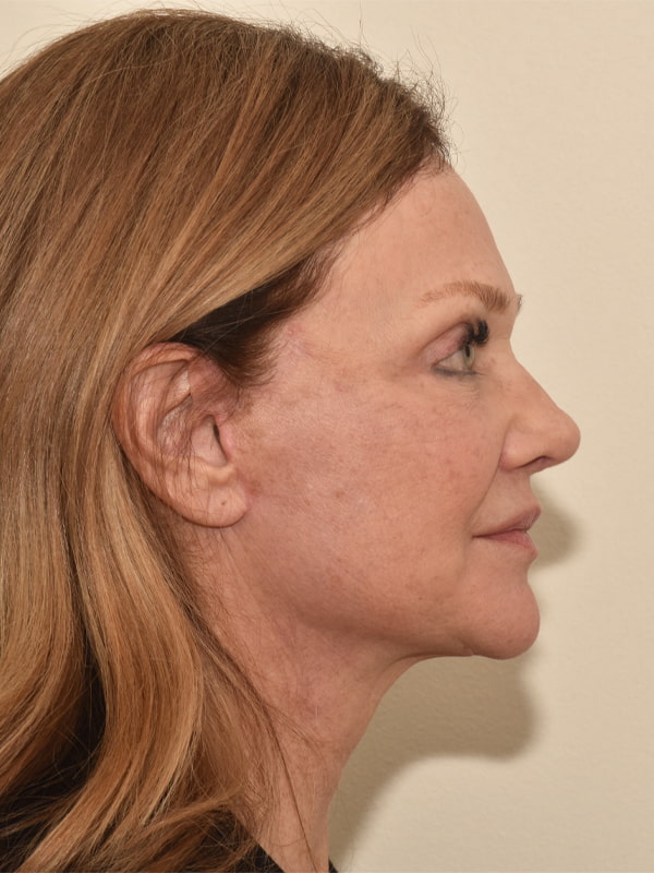 Facelift Before & After Image