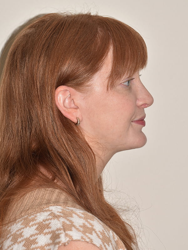 Rhinoplasty Before & After Image