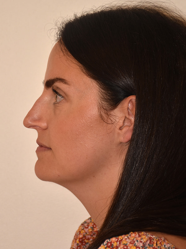 Rhinoplasty Before & After Image