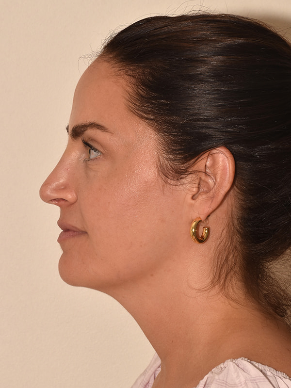 Rhinoplasty Before & After Image